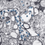 Parkinson'da Toksik Protein Birikimi Hedef Alındı